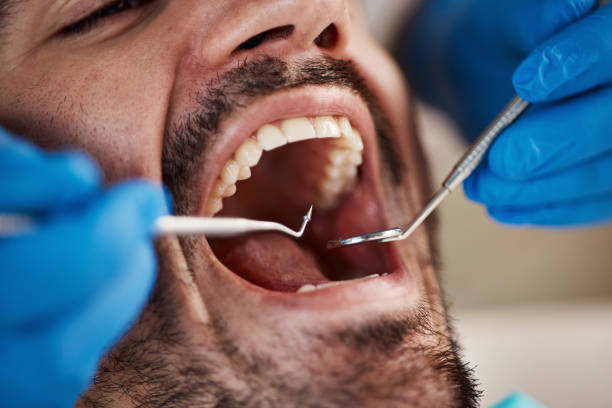 Best Dental Fillings (Composite and Amalgam)  in Mayo, MD